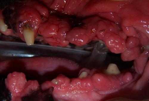 Severe gingival hyperplasia