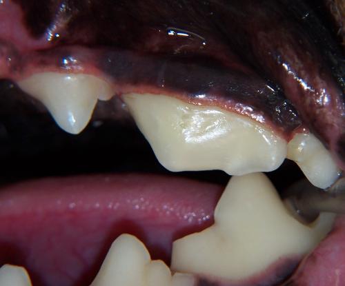 Restored fractured tooth with completed root canal