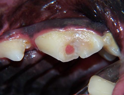 Complicated crown fracture with pulp exposure