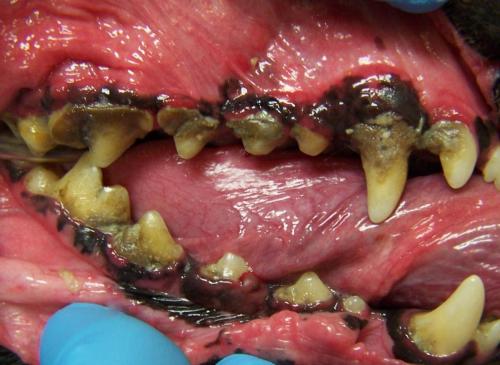 Grade III periodontal disease